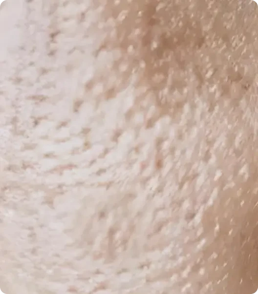 Pores dilatés et relâchés